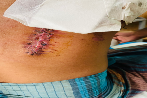 Ein Mann im Krankenhausbett mit einem verbundenen Bein und einer Narbe am Bauch, mit einer anderen Person und einem Tisch im Hintergrund.